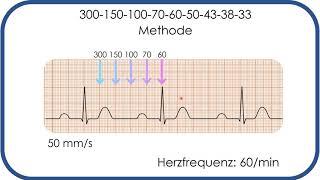 EKG-Befundung: Herzfrequenz in Sekunden bestimmen! (300-150-100-Methode)