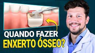 Descubra Quando VOCÊ NÃO VAI Escapar do Enxerto Ósseo no Implante DENTÁRIO