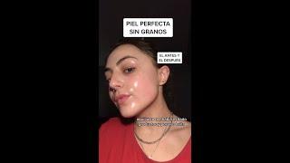 PIEL PERFECTA: Antes VS Después #skincare #skincareroutine #skincaretips #skin #acne #piel #pielsana