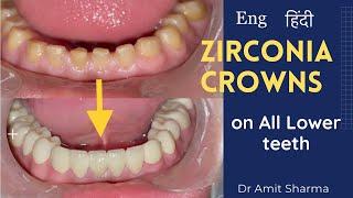 How teeth capping is done ?  zirconia crowns | Dental crowns | कैपिंग कैसे की जाती है ?