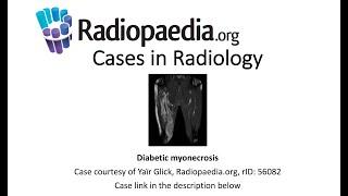 Diabetic myonecrosis (Radiopaedia.org) Cases in Radiology