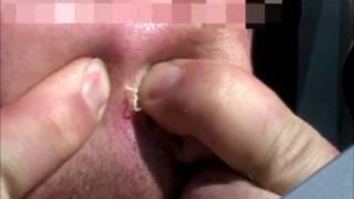 Huge Blackhead Gets Popped....