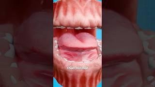 What Are Overgrown Gums?  Doctor Reacts
