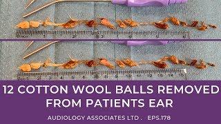 12 COTTON WOOL BALLS REMOVED FROM PATIENTS EARS - EP178