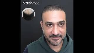 زراعة الشعر قبل وبعد | تقييم المرضى لعملية زراعة الشعر | نتيجة زراعة الشعر - بزرة ميد