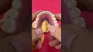 Metal Mesh Denture