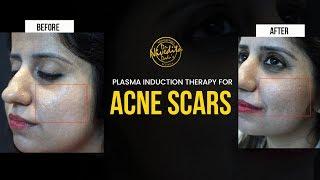 Plasma Induction Therapy for ACNE SCAR | Dr. Nivedita Dadu's Dermatology Clinic