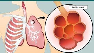 COPD and emphysema