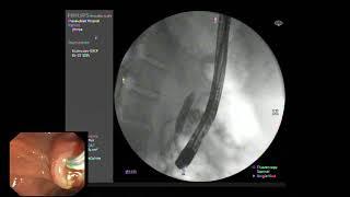 ERCP ; Post cholecystectomy bile duct injury Strasberg classification type E.