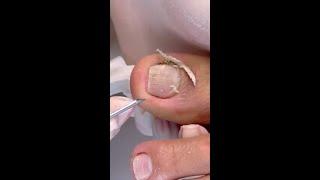 how to removed nail skin at home