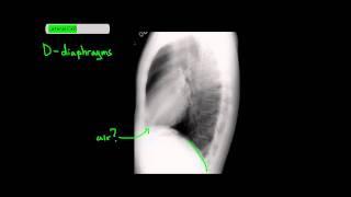 Method to Read Lateral Chest X-Rays [UndergroundMed]