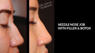 BEFORE & AFTER - Needle Nose Job in 5 minutes - by Dr. Rubbani