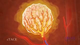 Liver Tumor Embolization & Chemoembolization