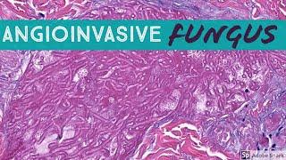 Angioinvasive Fungus = Dermatopathology Emergency!