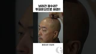 날라간 정수리? 두피문신으로 해결!!