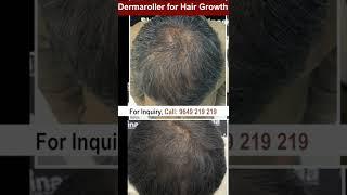 Derma Roller For Hair Growth Has The Answer To Everything #dermaroller_for_hairgrowth #skinaa_clinic