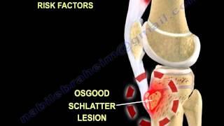 Osgood Schlatter Disease - Everything You Need To Know - Dr. Nabil Ebraheim