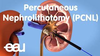 Removal of kidney stones: PCNL