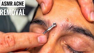 ASMR HEAD MASSAGE • Acne removal • Turkish Barber