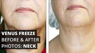 Venus Freeze™ Before & After Photos: Neck