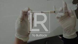 Renuva Fat Grafting to Buttock Dimpling/Irregularities