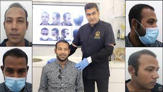 Hair Transplant Malaysia | SMART™ FUE Hair Transplant: 3-Month Review