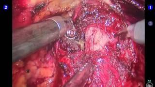 Incision of the bladder neck - Mesane boynu insizyonu