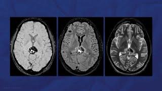 Supracerebellar-Infratentorial Approach for Resection of Midbrain Cavernous Malformation