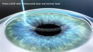 Zeiss - LASIK with femtosecond laser and excimer laser