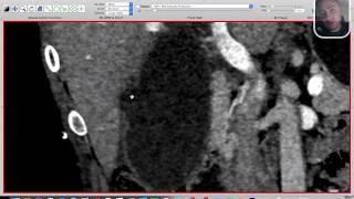 | GIT | Emergency | Acute cholecystitis | 2