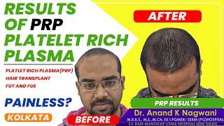 Great PRP Results in Kolkata  | Hair Regrowth | Platelet-rich plasma | Kolkata | Dr Nagwani