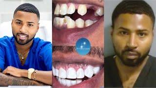 FAKE VENEER TECHS get ARRESTED after getting CAUGHT doing VENEERS With no license or certifications