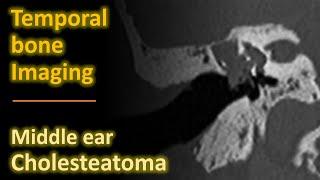 Temporal Bone Imaging - Cholesteatoma