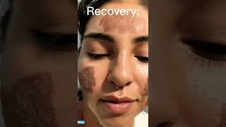 We Treated Her Acne in just One Day! #skincare #beauty #shorts #laser