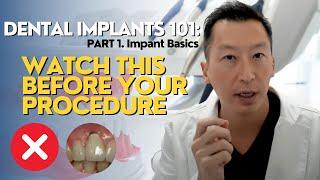 Dental Implants 101: What You NEED to Know! Part 1 (Implant Basics)