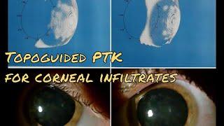 Corneal LASER Surgery: Transepi Topography-guided PTK for treatment of adenovirus nummular keratitis