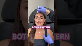 Botox marking pattern #botox101 #botoxmarking #botoxpatterns #botoxinjections #injections