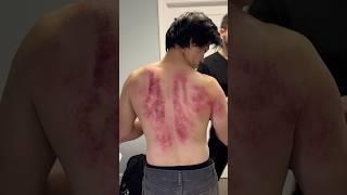 Holy Smokes  Cracks & Insane Gua Treatment! #shorts #chiropractor