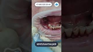 Имплантация зубов пациенту.