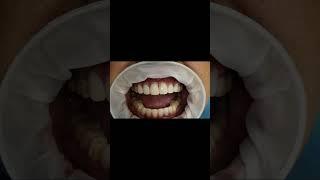 Estheic GCam anterior bridge for Simpladent multiunit implants(over Titanium bar )!!