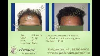 Review of Hair Transplant for Elegance Clinic, Dr. Ashutosh Shah, Surat, Gujarat, India.