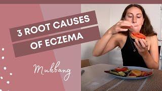 3 MAJOR Root Causes of Eczema (MUKBANG) / Itchy, red skin