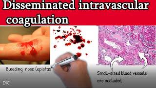 Disseminated intravascular coagulation (DIC) - Causes, Symptoms, Treatment and prognosis