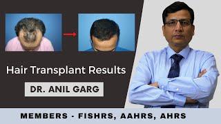 Hair Transplant Result | Result of Best Hair Restoration - Dr. Anil Garg and Dr. Seema Garg