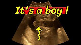 Gender determination, Its a baby boy