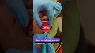 LIVE Laser Gum cutting; Gummy smile treatment; Dr. Srishti Bhatia