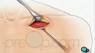 Permanent Pacemaker Implant Surgery  • PreOp® Patient Education 