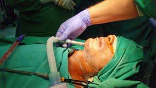 Submental Intubation & Extubation