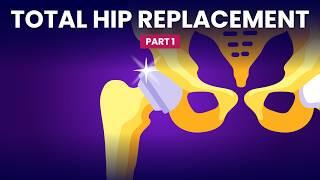 A Few Things Before You Replace Your Hip