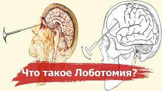 Лоботомия – кошмар 20 века | История самой ужасной операции